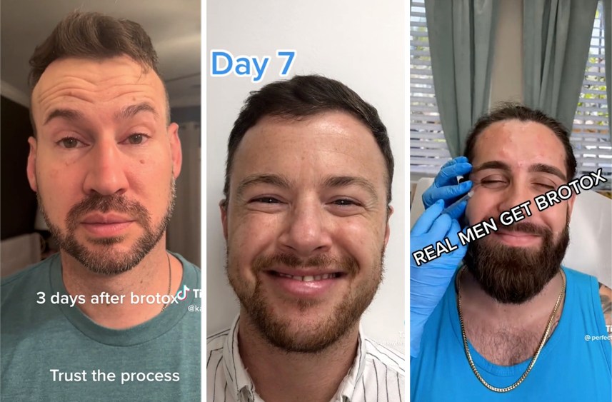 Men are increasingly going under the needle, taking to TikTok to document their "brotox" journeys.