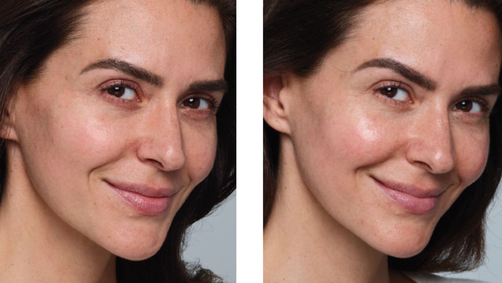 skinvive before and after, glowing skin, what is skinvive